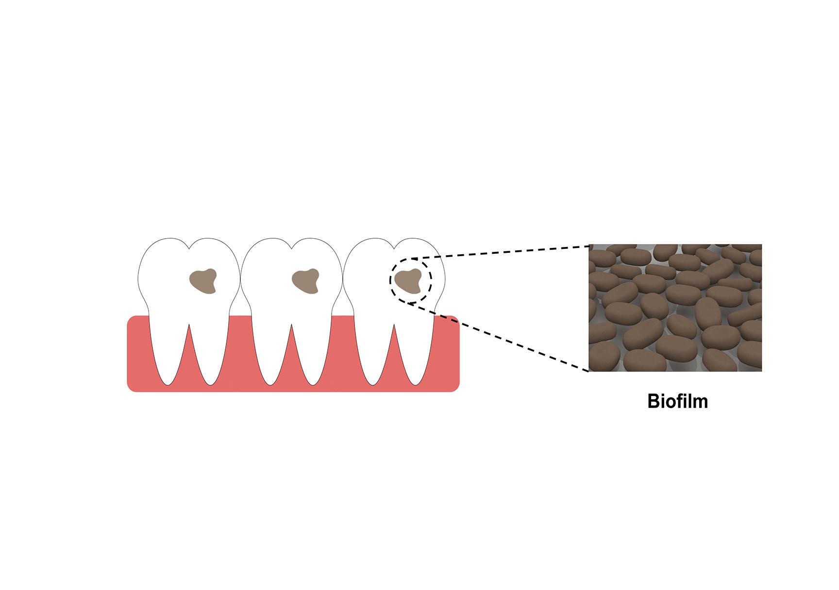由附着在牙齿表面的细菌和真菌形成的生物膜