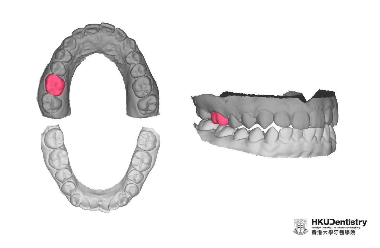The research team uses 3D GAN to learn the relationship of teeth in a dental arch on the 175 student participants. After training, 3D GAN is able to generate a tooth (red) based on the feature of remaining teeth (dark grey). Research team proposes further investigate the presence of opposing teeth helps the AI to generate a more natural tooth (red).